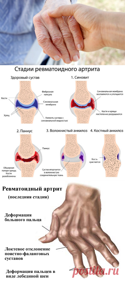 Ревматоидный артрит мышцы