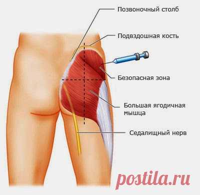 Внутримышечная инъекция в ягодицу: учимся делать самостоятельно.