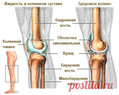 Жидкость в коленном суставе? Смотрите простейший способ избавиться от нее!