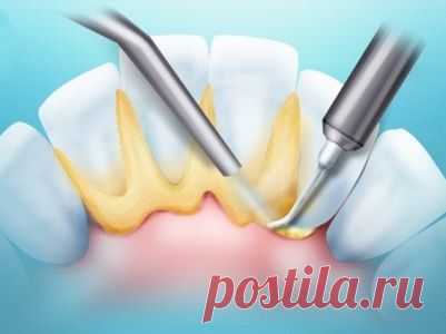 Зубной камень - как убрать народными средствами?