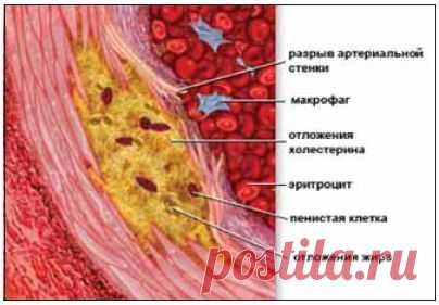 Лечение атеросклероза в домашних условиях | ПолонСил.ру - социальная сеть здоровья