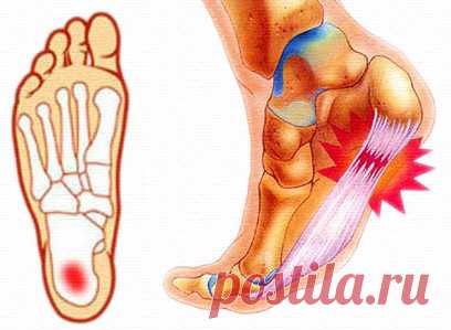 Пяточная шпора - как лечить без таблеток и операции?