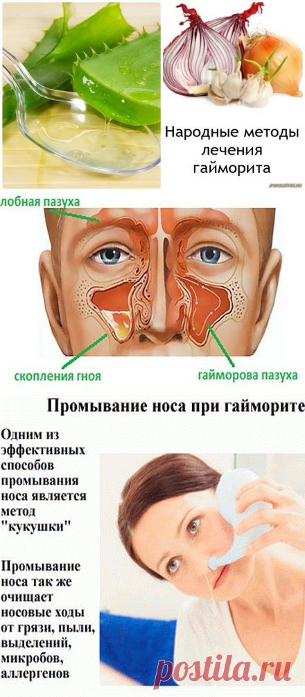 Гайморит лечение у взрослых. Лекарство для очищения пазух носа.