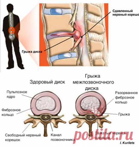 Беспокоит грыжа диска: вместо операции попробуй это!