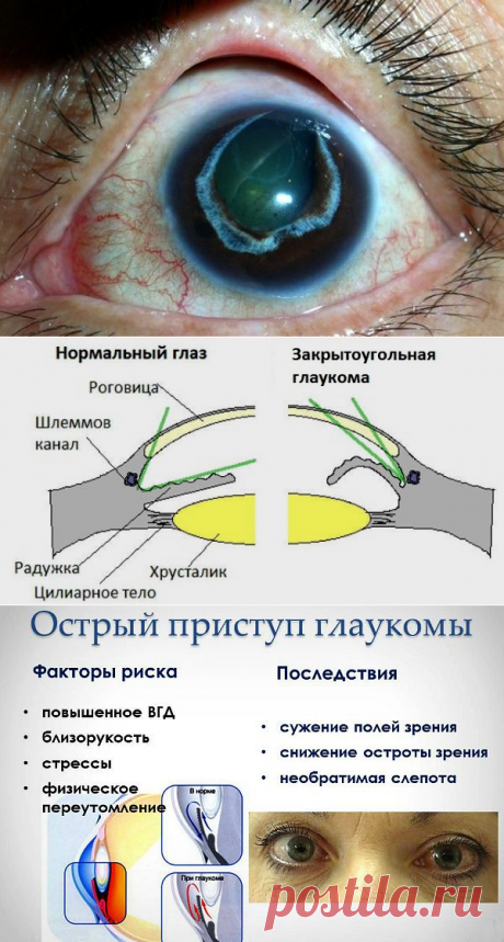 Возможно ли сохранить зрение после острого приступа глаукомы и чем экстренно снять симптомы