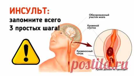 ИНСУЛЬТ: Запомните 3 простых шага, чтобы спасти жизнь себе или близким Инсульт прочно занимает первое место среди причин смертности. Взрослые, пожилые, и даже молодые, казалось бы, здоровые люди — инсульт может случиться с