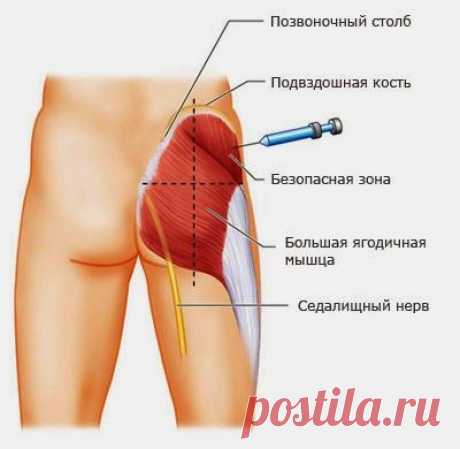 Внутримышечная инъекция в ягодицу: учимся делать самостоятельно