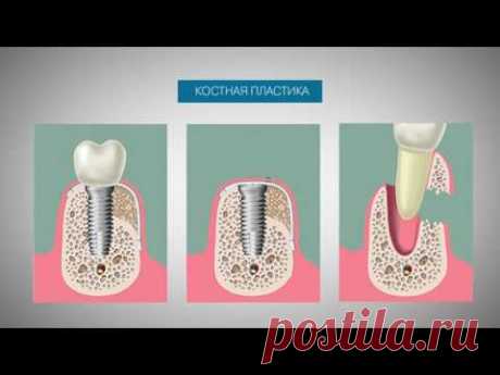 Видеоблог стоматолога  Вся правда об имплантации