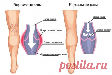 Самые эффективные упражнения против варикоза