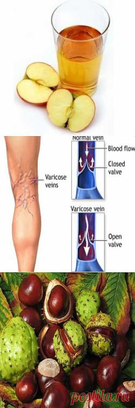 Natural Cure for Spider Veins -  How To Treat Spider Veins With Natural Cure | Girlishh.com