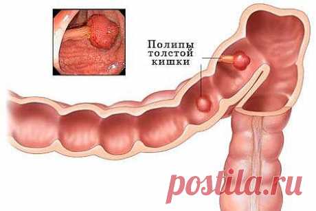 Полип толстой кишки: причины возникновения и симптомы заболевания
Если полип толстой кишки не удалить, он может стать причиной колоректального рака. А, между тем, обнаружить этот самый полип иногда ой как непросто - он не болит! Каковы причины развития полипа толстой кишки и как его выявить, знает автор данной статьи.