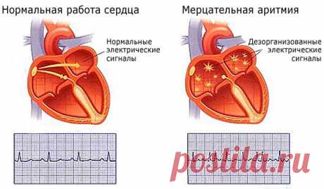 5 простых способов успокоить сердце при аритмии