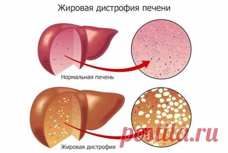 Натуральные настои при ожирении печени Ожирение печени легко поддается лечению — поможет правильное питание с низким содержанием жиров. Также вы можете готовить себе различные натуральные настои, которые помогут организму справится с болезнью.