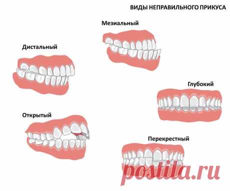 виды не правильного прикуса #дети #развитиедетей #речь #логопед