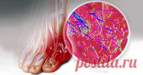 Вот как быстро вывести кристаллы мочевой кислоты из суставов и организма, а также остановить развитие подагры — Бабушкины секреты