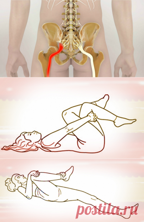 Как разблокировать седалищный нерв: 2 простых способа снять боль.
