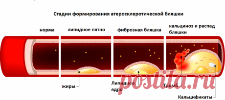 Чистка сосудов - убираем холестериновые бляшки. Возможно ли это? Ответ специалиста меня удивил | Дневник здоровья | Дзен