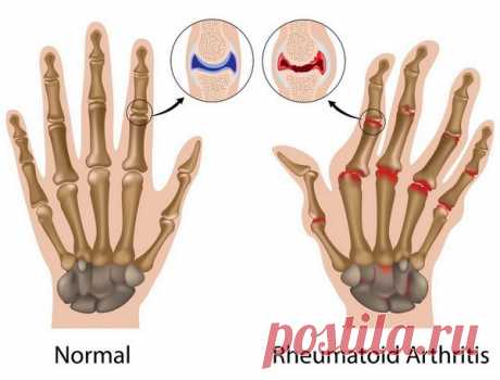 Упражнения при артрите пальцев рук для снятия боли и воспаления