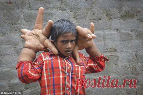 Мальчик с самыми большими руками
Индийский мальчик Кэлим, повергнет в шок любого. Ребёнок появился на свет с огромными руками, в два раза превышающими допустимые нормы. Сейчас Кэлиму 8 лет и его руки, вес которых превышает 12 килограммов, продолжают расти, озадачив местных  врачей, которые не знают, что с этим делать.