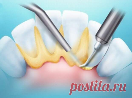 ЗУБНОЙ КАМЕНЬ - КАК УБРАТЬ НАРОДНЫМИ СРЕДСТВАМИ...