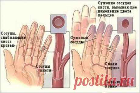 НАРОДНЫЕ СРЕДСТВА ОТ ОНЕМЕНИЯ РУК И НОГ