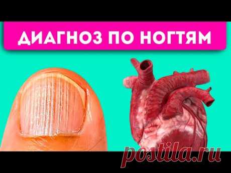 Маникюр не спасет! 8 проблем с ногтями, которые укажут на сердце, легкие, желудок и даже …