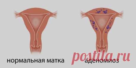 Что нужно знать женщинам об аденомиозе матки Средний возраст женщин, у которых возникает аденомиоз, – 30 лет и старше, и обычно это рожавшие женщины.