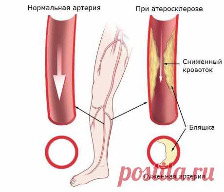Атеросклероз артерий нижних конечностей - лечение и симптомы