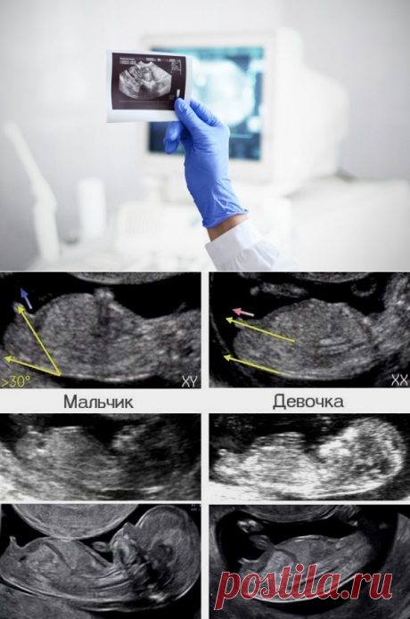 Может ли ошибаться процедура УЗИ с определением диагноза, беременностью и полом ребенка