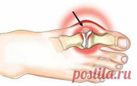 Подагра - лечение народными средствами