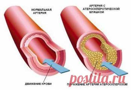 Как очистить сосуды от холестериновых отложений? | Быть здоровым легко!
