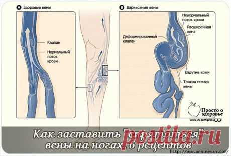 Как заставить ''спрятаться'' вены на ногах. 6 рецептов