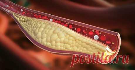 Ключевой момент в профилактике атеросклероза, инфаркта, гипертонии и инсульта!