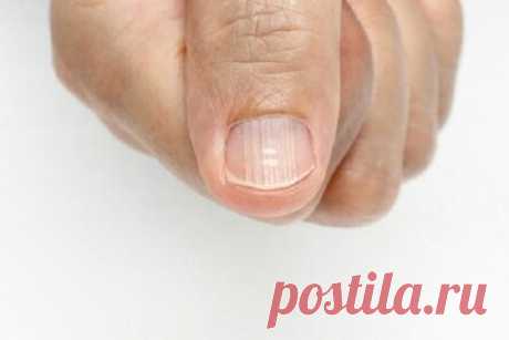 Полоски на ногтях: откуда они и как предотвратить их появление?