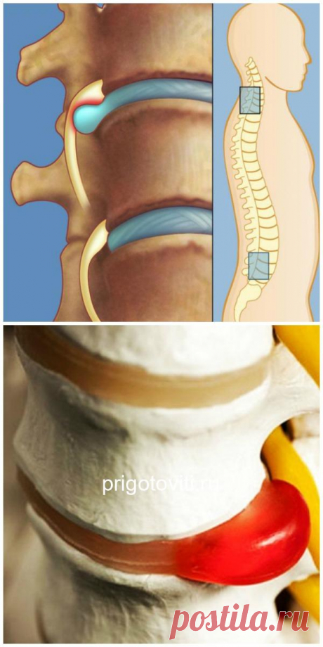 Лечение межпозвоночной грыжи без лекарств и операции: упражнения для спины от Шамиля Аляутдинова - Все своими руками