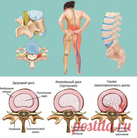 Межпозвонковая грыжа: Лечение народными средствами