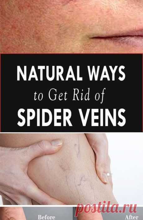 3 Natural Ways To Get Rid Of Spider Veins