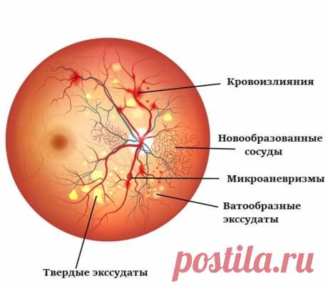 Миллиарды на диабете. Расследование «Человек и Закон» вскрыло масштабный заговор врачей и фармацевтов против населения России