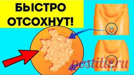 Папилломы отпадут за сутки. Самый простой способ удаления висячих родинок в домашних условиях дёшево