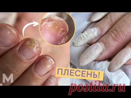 ПЛЕСЕНЬ НА НОГТЯХ: ЛАЙФХАК 😜 СПЛОШНЫЕ ОТСЛОЙКИ и ТРЕЩИНЫ 😱Как лечить плесень под гель лаком.