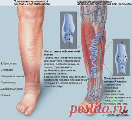 Варикоз и сосудистые &quot;звездочки&quot; на ногах - простое решение проблемы..