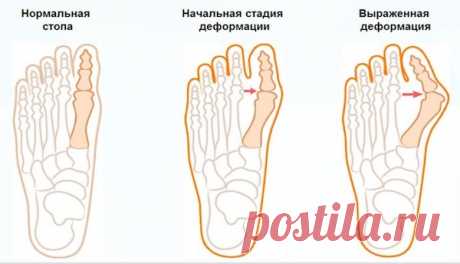 Растущие косточки на ногах - народные методы лечения доступные каждому 
По-научному этот недуг называется вальгусная деформация стопы. Заболевание, признаем, не смертельное, но крайне неприятное. Основные признаки − рост «шишечки» на большом пальце ноги, искривление. По …