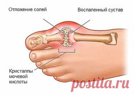 Травы для устранения кристаллизации мочевой кислоты в суставах и избавления от подагры! Травы для устранения кристаллизации мочевой кислоты в суставах и избавления от подагры!

Применяя эти советы, я избавился от приступов подагры и уже 2 года живу без болей!
Есть много трав, которые пом…