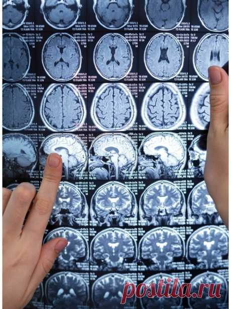 СО РАН: инсульт вызывает перестройку работы всего головного мозга | МК в Новосибирске | Дзен