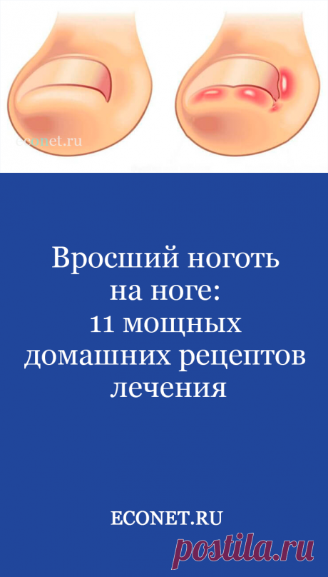 Вросший ноготь на ноге: 11 мощных домашних рецептов лечения

Имея на вооружении наши 11 методов, как лечить вросший ноготь на ноге, проблема больше не доставит вам дискомфорта. В первый же день, как только врос ноготь, начинайте лечение. А еще лучше помните о профилактике недуга, ведь методы предотвращения заболевания намного проще, чем лечение вросшего ногтя.