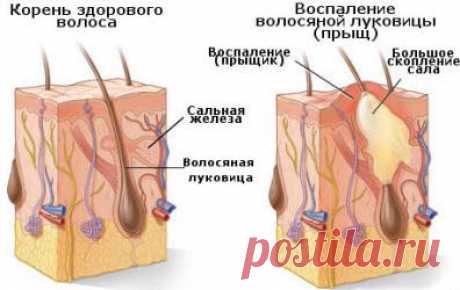 Прыщи на голове: фото, причины и лечение + народные методы