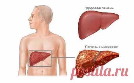 Цирроз печени - народное лечение | Народная медицина