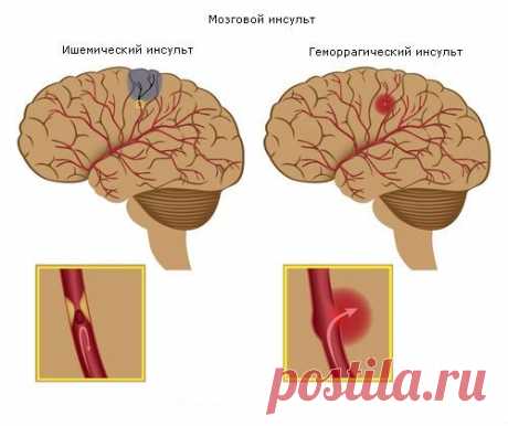 Последствия инсульта головного мозга.