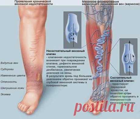 Лечение варикоза народными способами | Правила здоровья и долголетия