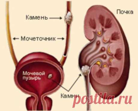 Как предотвратить образование камней в почках и желчном?